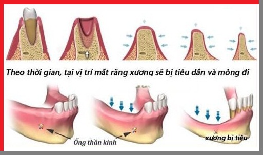 tieu-xuong